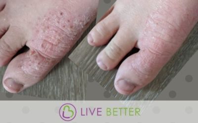 Healing Eczema Holistically From The Inside Out